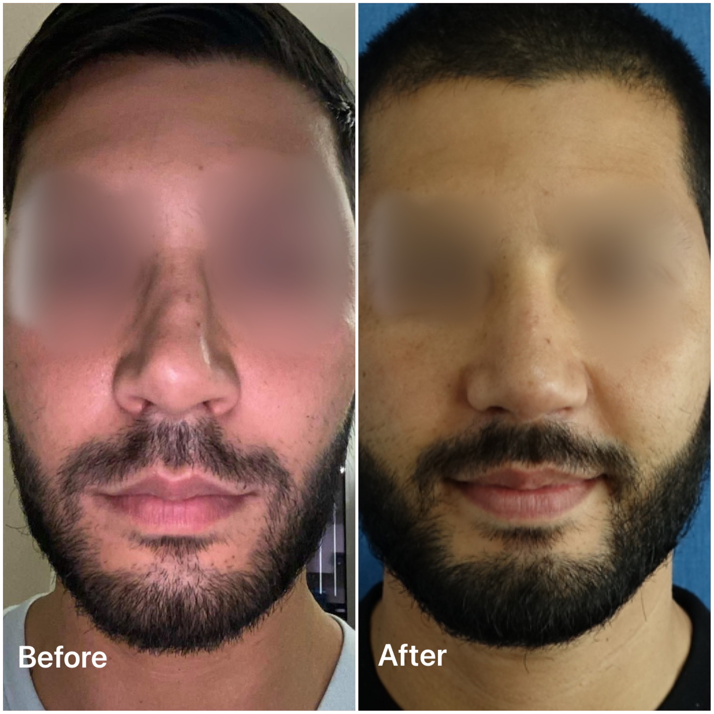 Best Rhinoplasty Dubai Surgeons for Nose Surgery