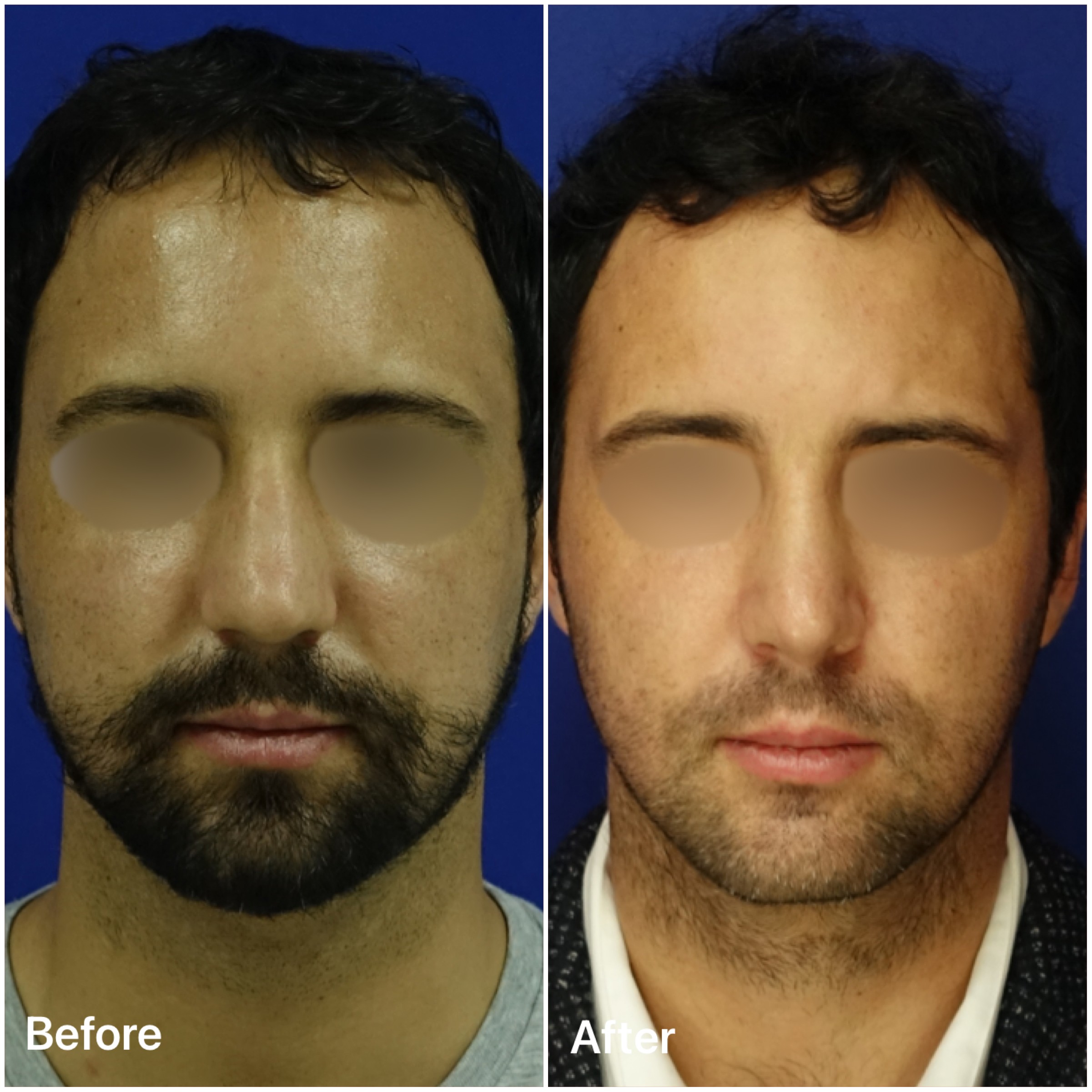 Best Rhinoplasty Dubai Surgeons For Nose Surgery