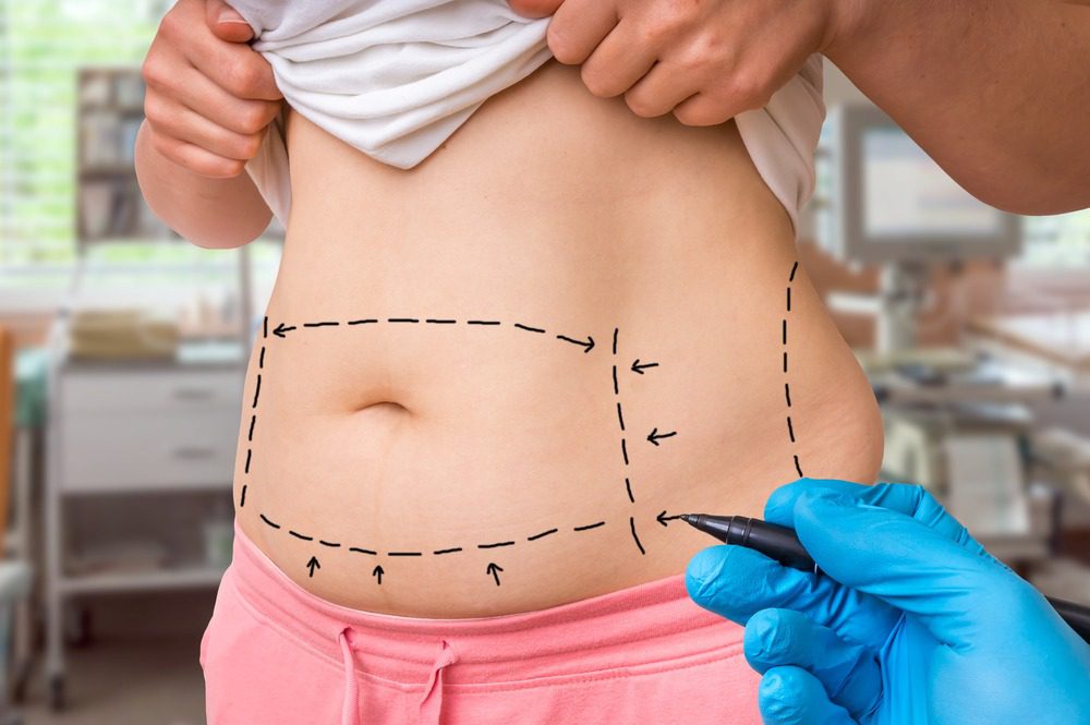 Tummy Tuck Dubai