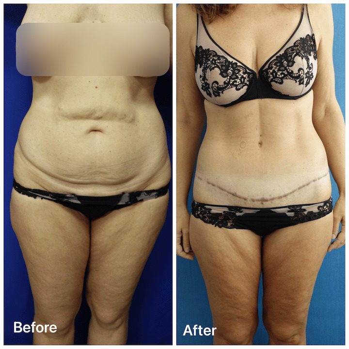 tummy_tuck_before_and_after2