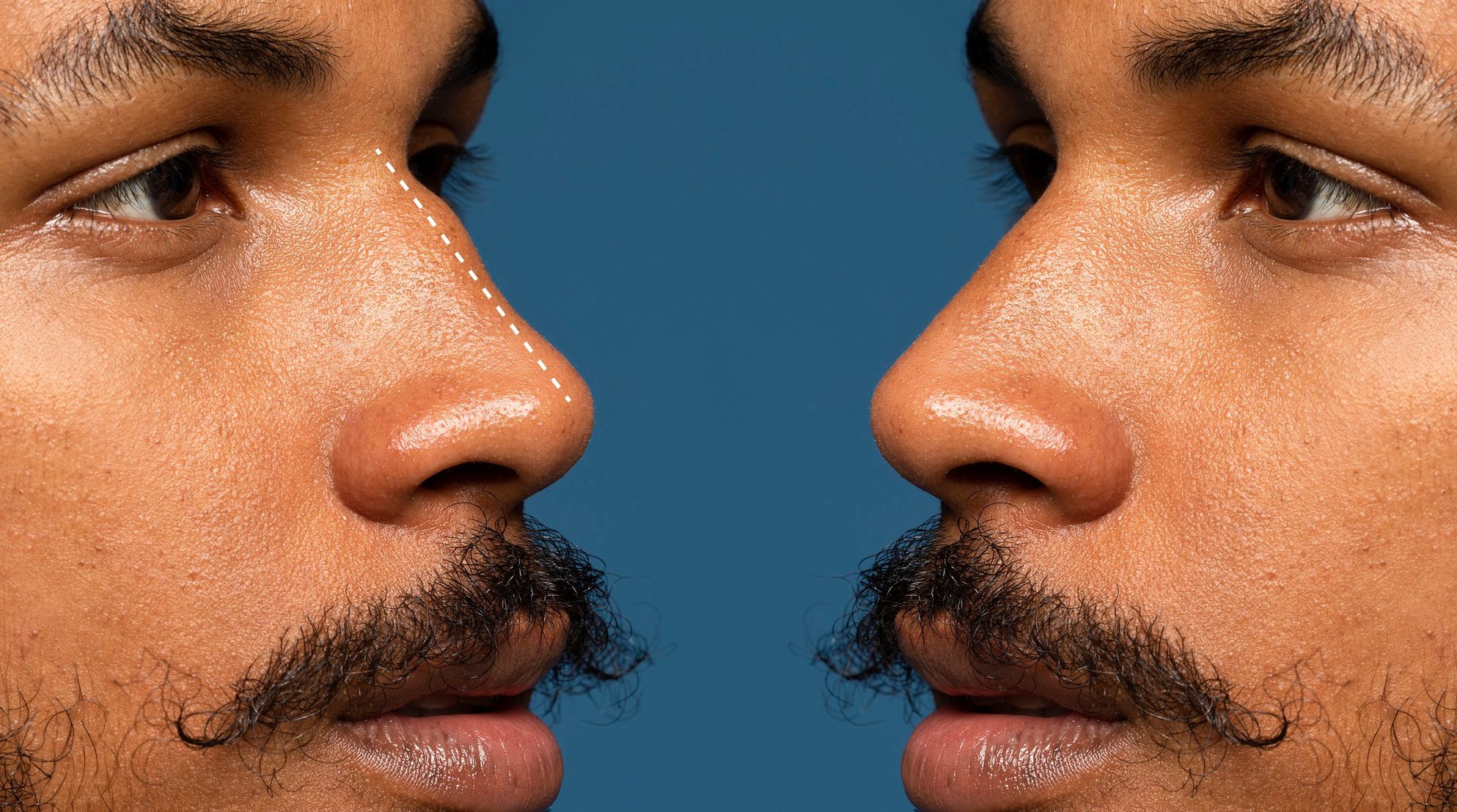 Male Rhinoplasty Surgery